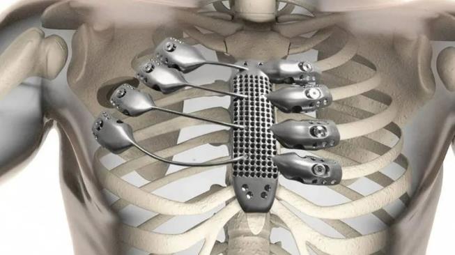 钛在人体中的应用主要体现在医疗器械与植入物方面